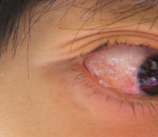 目 に 膜 が 張る 病気